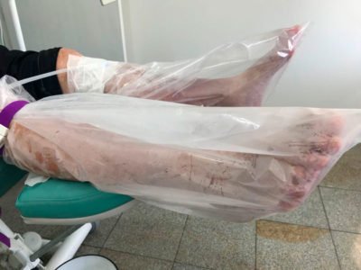 Tratamento de feridas e curativos com técnicas avançadas e ozonioterapia em Sorocaba