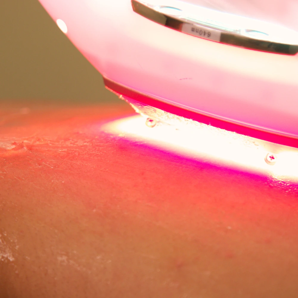 Sessão de Laserterapia para cicatrização e alívio da dor