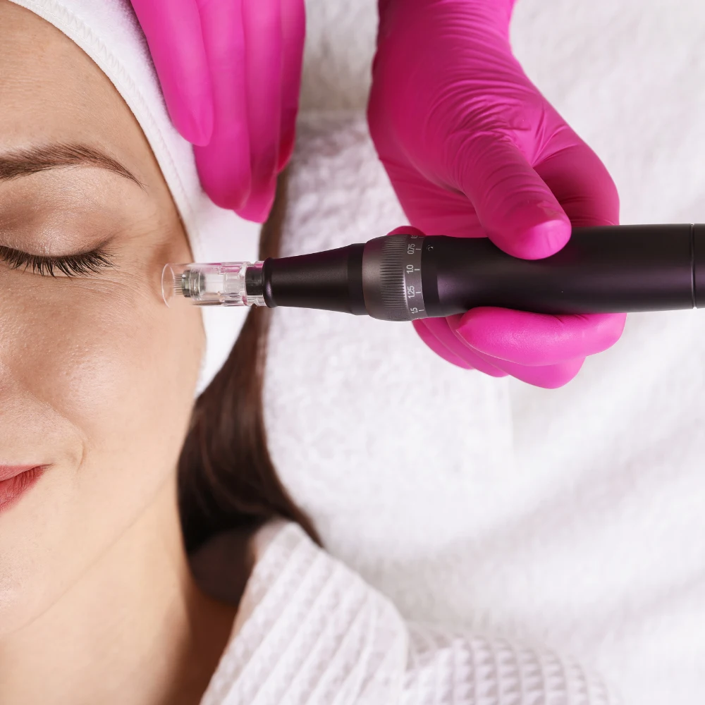Procedimento de microagulhamento estético facial em clínica